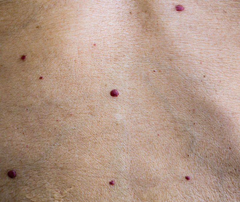 Cherry Angioma treatment in sussex