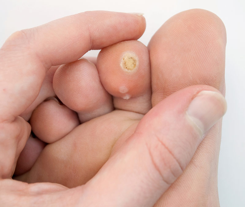 Effective Verruca Removal east sussex