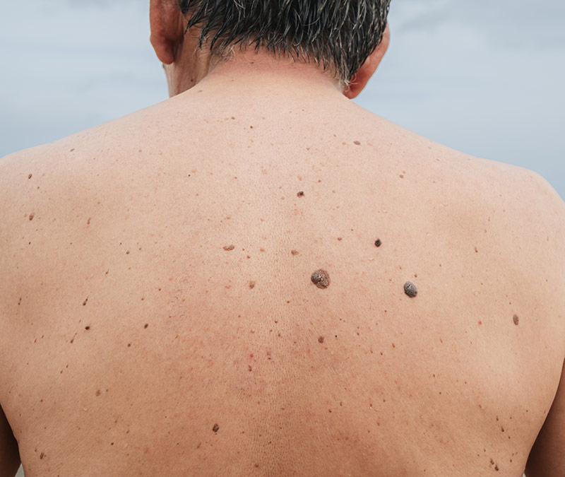 Keratosis Seborrhoica Age Spots removal