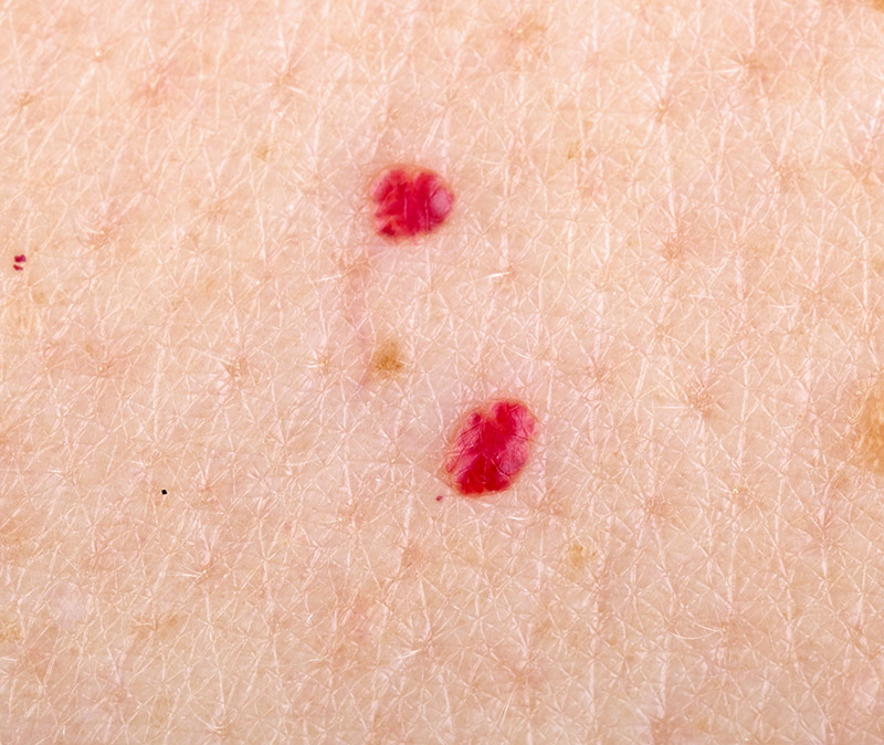 best cherry Angioma treatment eastbourne best cherry Angioma treatment eastbourne