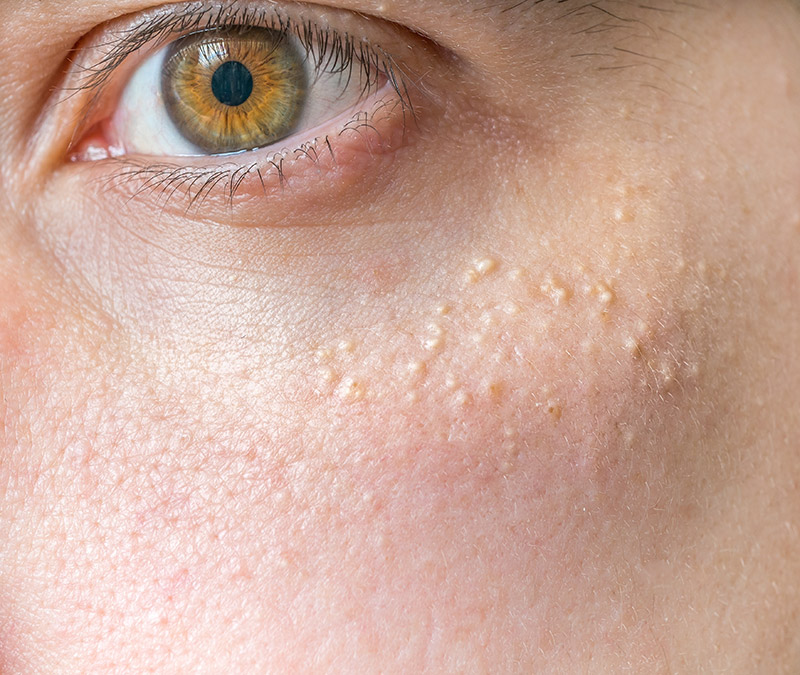 best eastbourne milia treatment