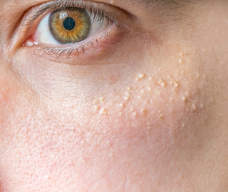 best milia treatment clinic eastbourne best milia treatment clinic eastbourne