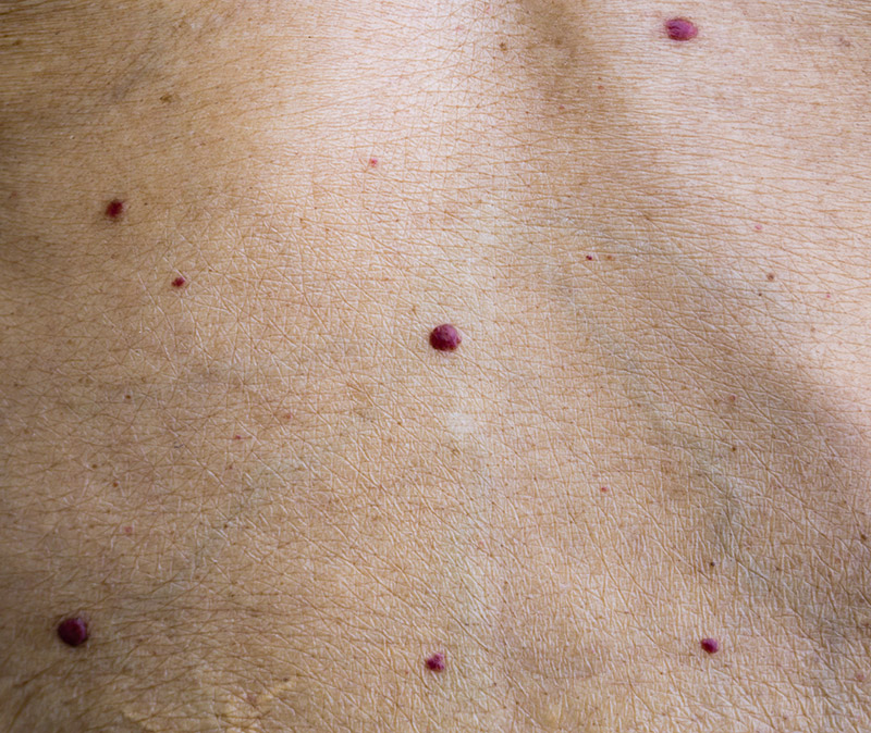 cherry angioma removal and treatment eastbourne cherry angioma removal and treatment eastbourne