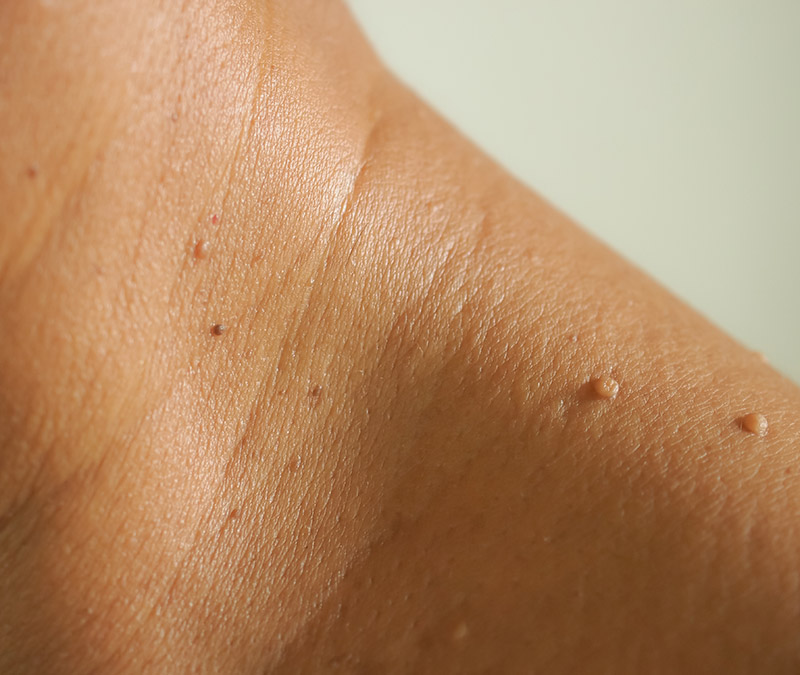 eastbourne skin tag removal