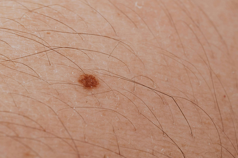 map my mole service sussex