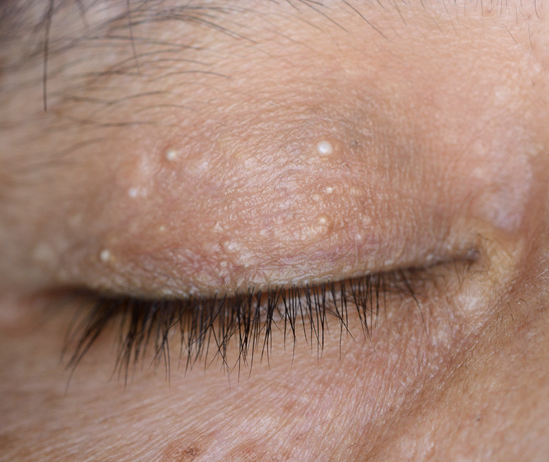 milia treatment eastbourne milia treatment eastbourne