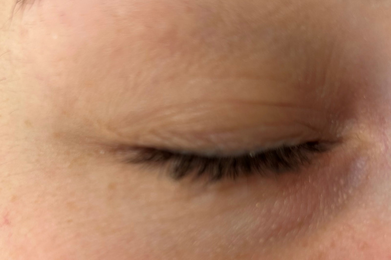 milia treatment in eastbourne after