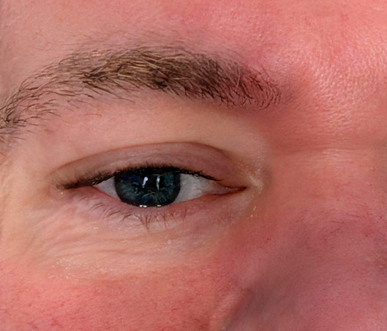 mole removal after eastbourne