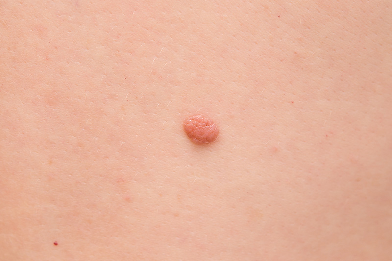 mole removal treatment eastbourne