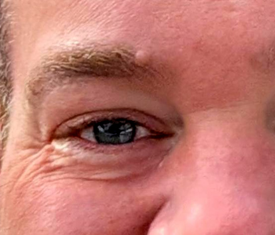 remove mole treatment before eastbourne