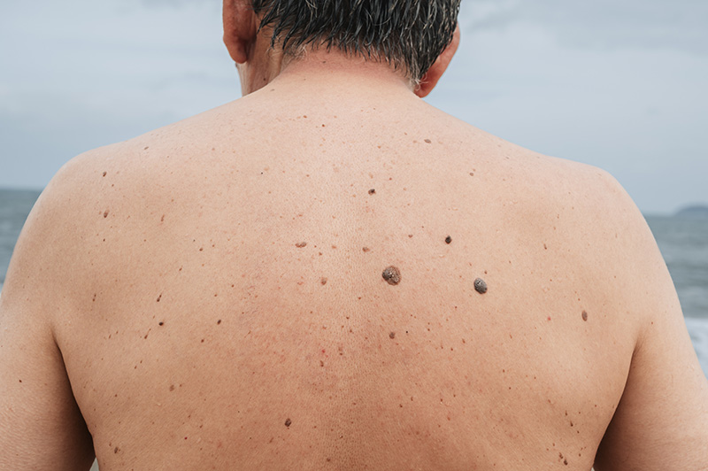 seborrhoeic keratosisage spot removal