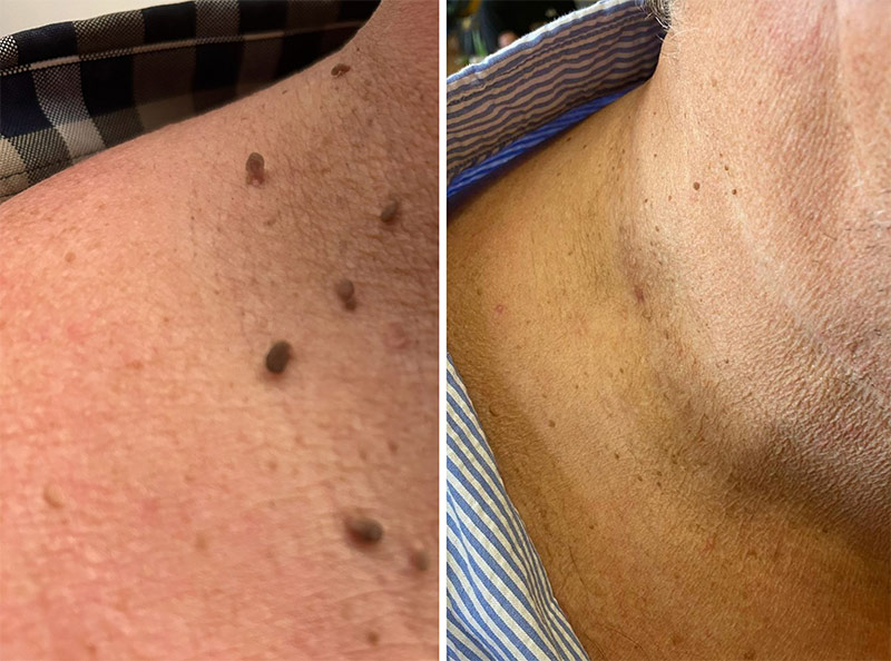 skin blemishes clinic eastbourne