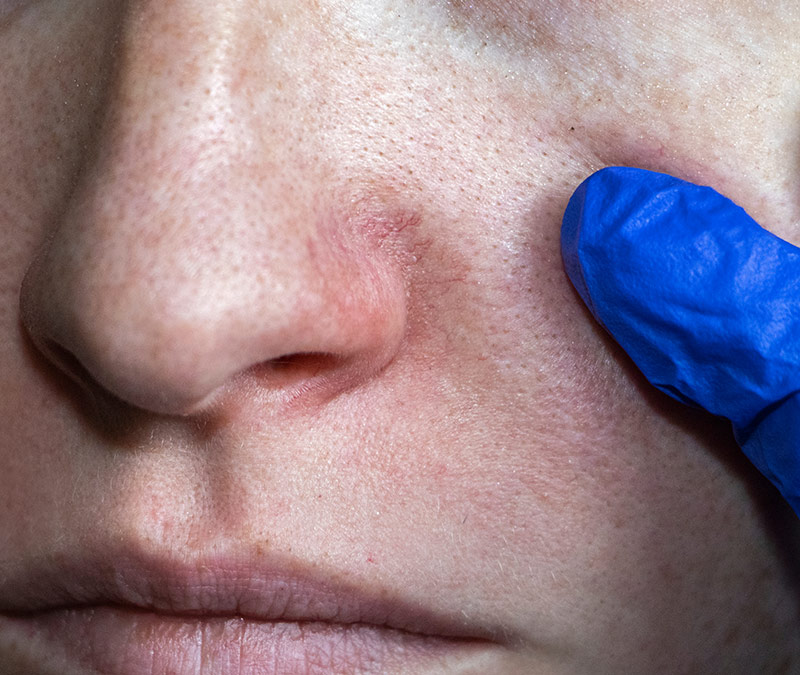 thread vein Shortwave diathermy treatment