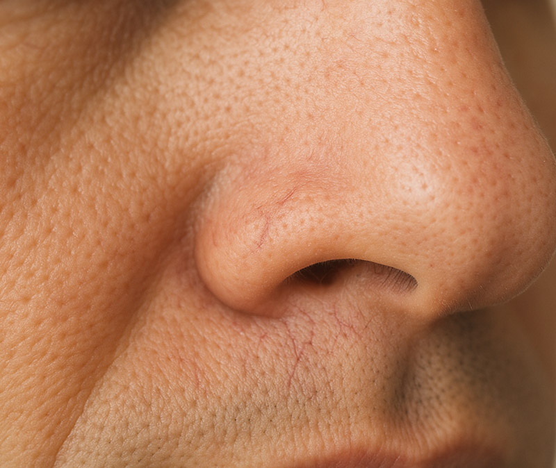 thread vein removal eastbourne sx thread vein removal eastbourne sx