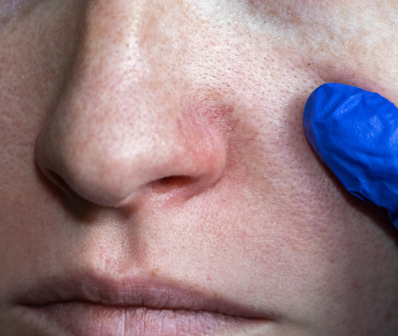 thread vein treatment eastbourne thread vein treatment eastbourne