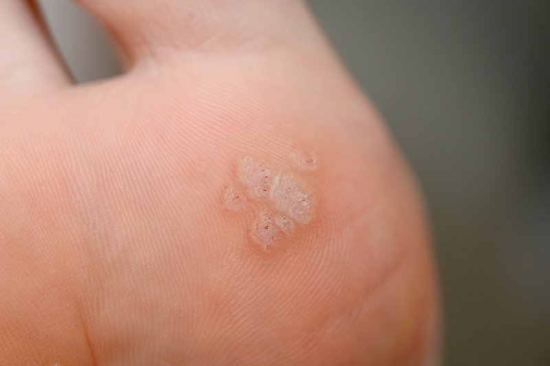 verruca removal removing eastbourne