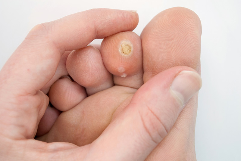 verruca treatment removal eastbourne