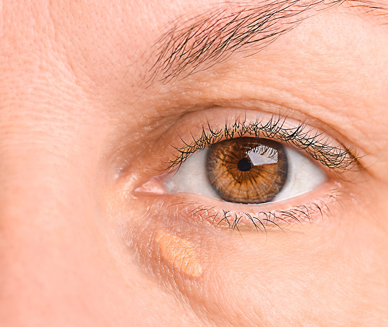 xanthelasma Cholesterol Deposit removal sussex
