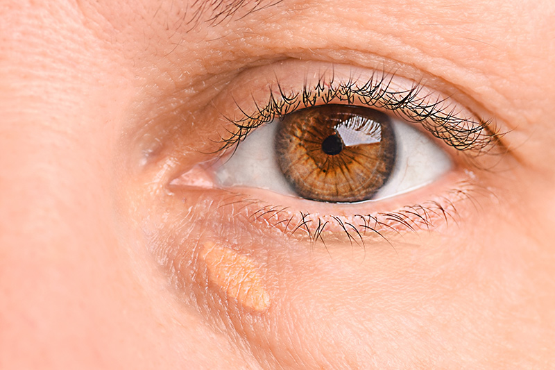 xanthelasma Cholesterol Deposit removal