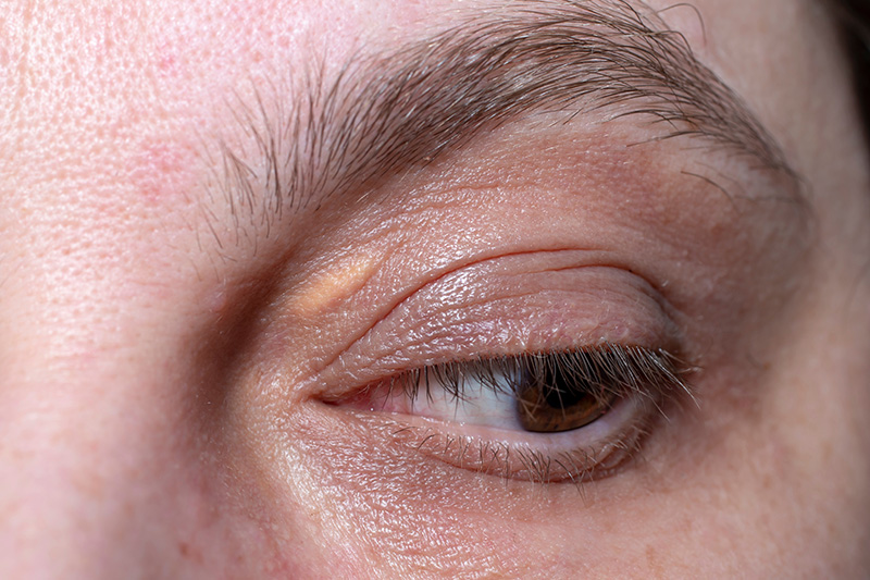 xanthelasma Cholesterol removal eastbourne